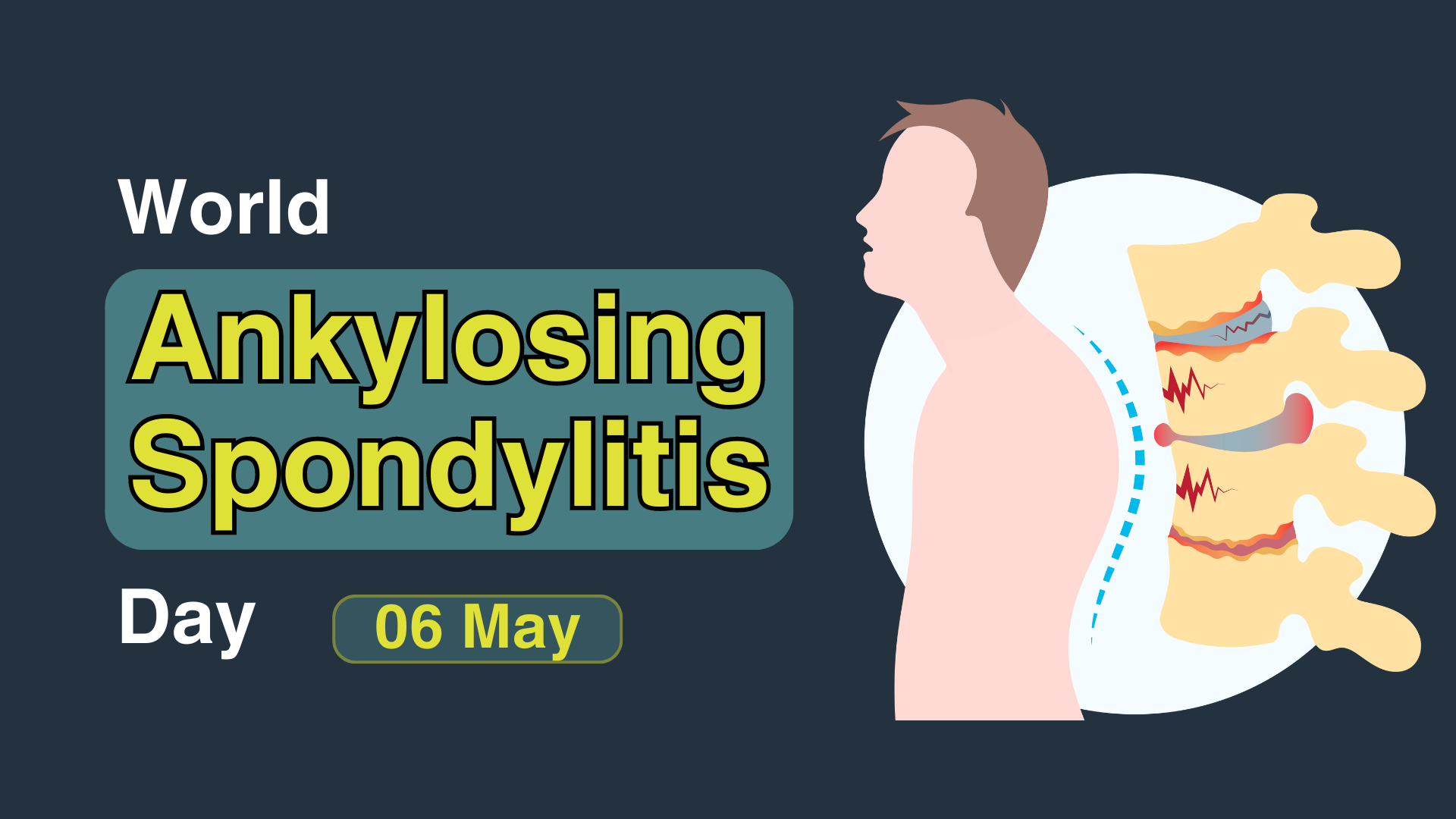 World Ankylosing Spondylitis Day, 6 May 2024